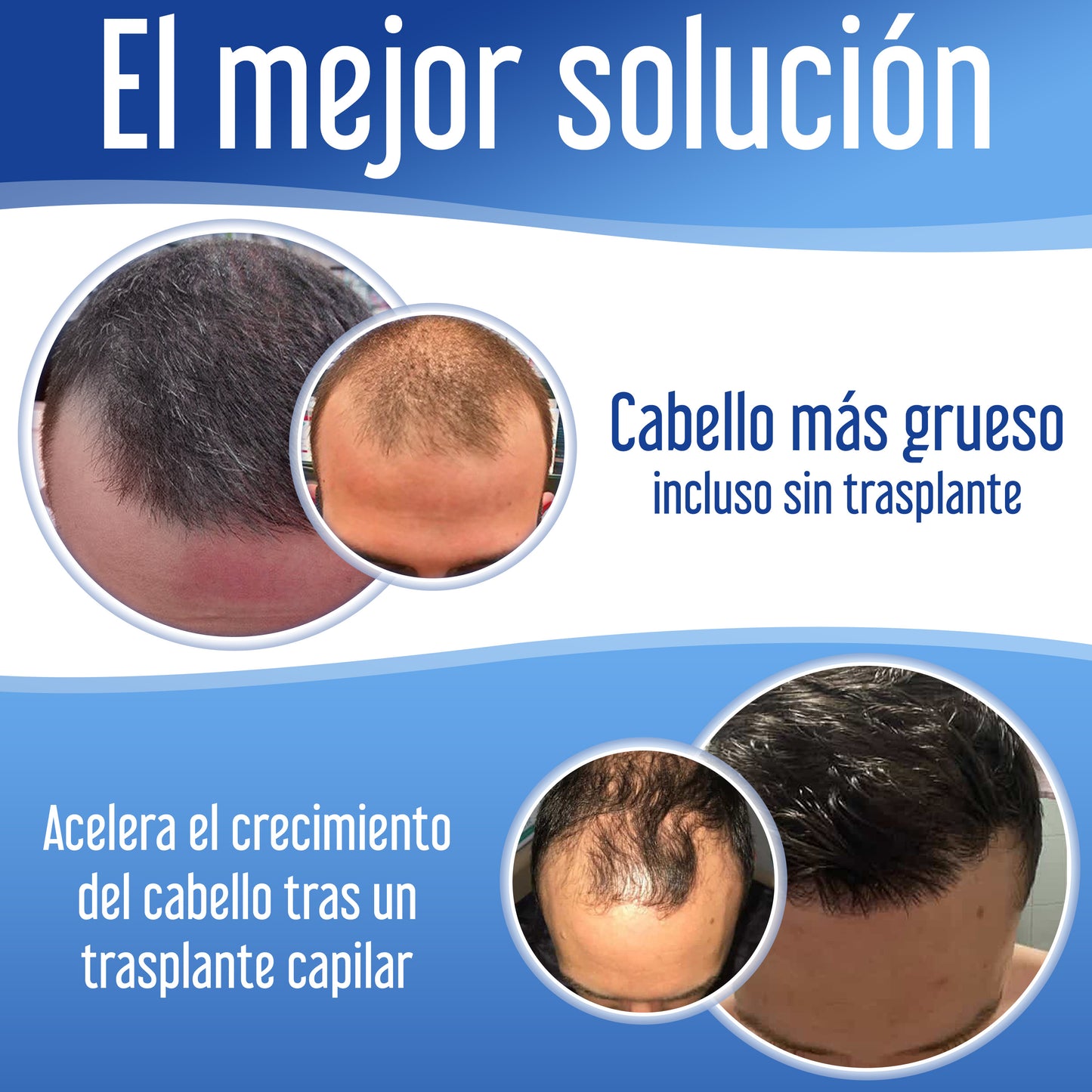 Xpecia Tablet hombre vitaminas para alopecia androgénica, Bloquea DHT, con Saw palmetto, Biotina, 60 comprimidos